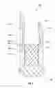 Fig. 03 - Drilling and completion deflector