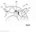 Fig. 06 - Gear pump with improved inlet port