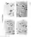 Fig. 02 - DIAGNOSIS AND TREATMENT OF NEUROECTODERMAL TUMORS