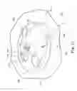Fig. 08 - Catheter systems having flow restrictors