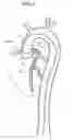 Fig. 07 - Intravascular foreign matter suction assembly