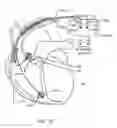 Fig. 37 - Frequency selective passive component networks for active implantable medical devices utilizing an energy dissipating surface