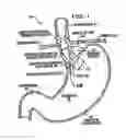 Fig. 02 - Transesophageal gastric reduction method and device for practicing same