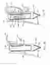 Fig. 06 - Transesophageal gastric reduction method and device for practicing same