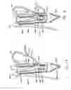 Fig. 09 - Transesophageal gastric reduction method and device for practicing same