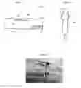 Fig. 04 - SURGICAL REMOVAL OF INTERNAL TISSUE