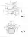 Fig. 02 - Method of treating a degenerate spinal segment