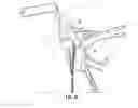 Fig. 33 - System for treating proximal humeral fractures and method of using the same