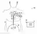 Fig. 01 - Method and apparatus for gastrointestinal stimulation via the lymphatic system