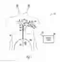 Fig. 02 - Method and apparatus for gastrointestinal stimulation via the lymphatic system