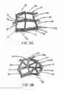 Fig. 03 - Intraluminal stent graft