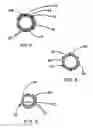 Fig. 04 - Intraluminal stent graft