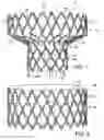 Fig. 02 - MITRAL VALVE REPLACEMENT WITH ATRIAL ANCHORING