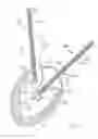 Fig. 04 - Method For Replacing Native Valve Function Of A Diseased Aortic Valve