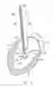 Fig. 06 - Method For Replacing Native Valve Function Of A Diseased Aortic Valve