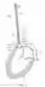 Fig. 07 - Method For Replacing Native Valve Function Of A Diseased Aortic Valve