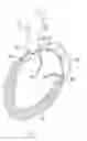 Fig. 08 - Method For Replacing Native Valve Function Of A Diseased Aortic Valve