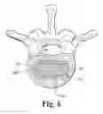 Fig. 03 - Open intervertebral spacer