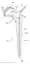 Fig. 01 - Antibiotic delivery system and method for treating an infected synovial joint during re-implantation of an orthopedic prosthesis