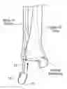 Fig. 01 - Fibular stiffener and bony defect replacer