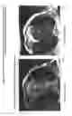 Fig. 06 - Long T1 artifact suppression techniques for magnetic resonance imaging