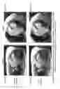 Fig. 14 - Long T1 artifact suppression techniques for magnetic resonance imaging