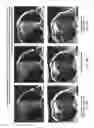 Fig. 22 - Long T1 artifact suppression techniques for magnetic resonance imaging