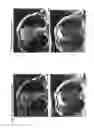 Fig. 23 - Long T1 artifact suppression techniques for magnetic resonance imaging