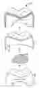 Fig. 01 - RESTORATION, RESTORATION COMPONENTS, AND METHODS OF MAKING A DENTAL RESTORATION