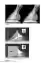 Fig. 02 - METHOD OF MEASURING QUALITY OF THE EQUINE DISTAL PHALLANGE FROM A LATERAL-MEDIAL RADIOGRAPH
