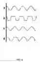 Fig. 09 - Vibration method for clearing acute arterial thrombotic occlusions in the emergency treatment of heart attack and stroke