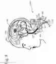 Fig. 09 - Devices and systems for selective auto-retroperfusion of the cerebral venous system