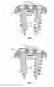 Fig. 04 - Method and apparatus for retaining screw in a plate