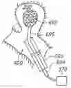Fig. 01 - SYSTEMS AND METHODS OF DE-ENDOTHELIALIZATION