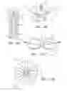 Fig. 05 - Detachable aneurysm neck bridge