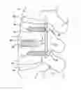 Fig. 01 - Method Of Surgically Implanting A Spinal Implant