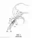 Fig. 02 - Sheaths for implantable fixation devices