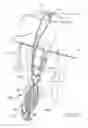 Fig. 08 - Apparatus and method for manipulating a flexible strand and soft tissue replacement during surgery