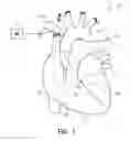 Fig. 02 - Methods for using a pulmonary artery electrode
