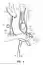 Fig. 04 - Methods for using a pulmonary artery electrode