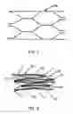 Fig. 02 - Intraluminal stent graft