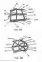 Fig. 03 - Intraluminal stent graft