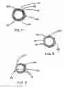 Fig. 04 - Intraluminal stent graft