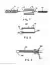Fig. 05 - Intraluminal stent graft