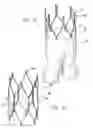 Fig. 04 - Mechanism for securing to a corporeal lumen and method of manufacturing