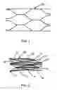 Fig. 02 - Intraluminal stent graft