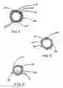 Fig. 04 - Intraluminal stent graft
