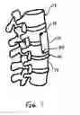 Fig. 02 - VESSEL PROTECTION DEVICE