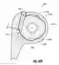 Fig. 32 - Elbow prosthesis