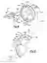 Fig. 55 - Elbow prosthesis